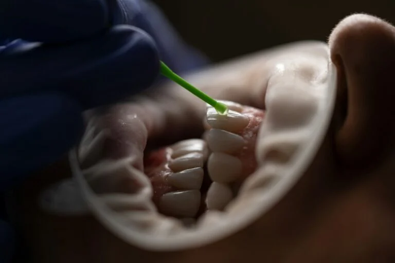The Benefit of Composite Bonding for Minor Teeth Imperfections