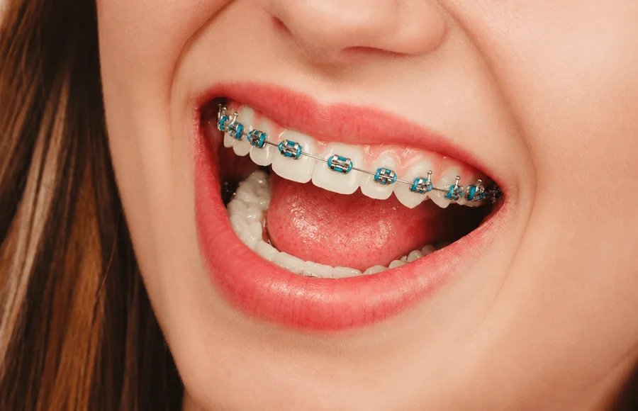 fixed-braces