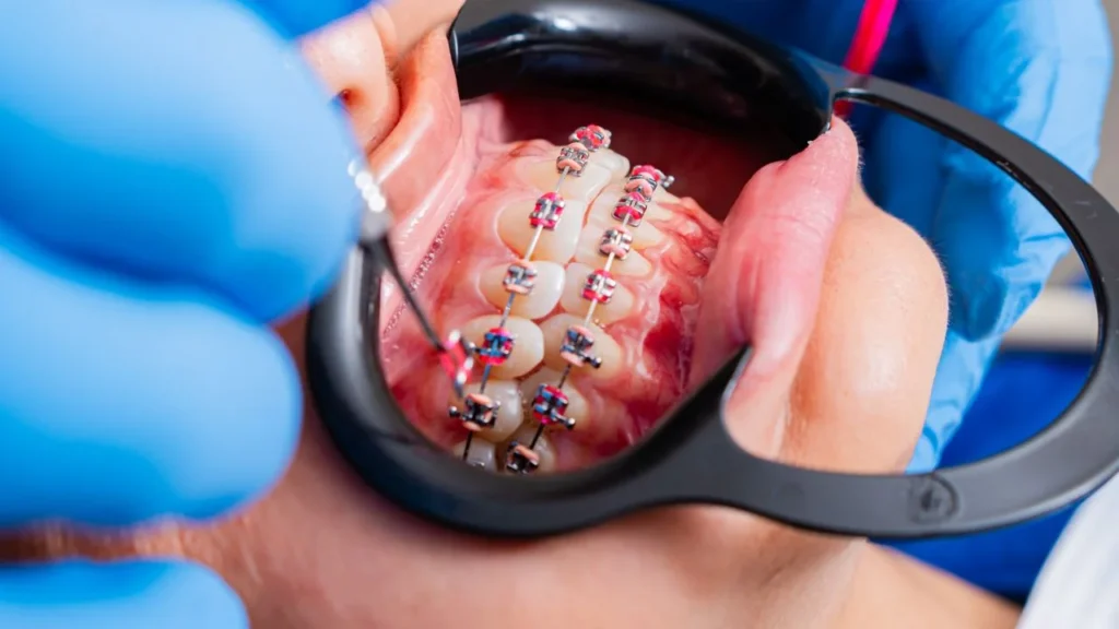 Braces or Invisalign in Merley for Back-to-School Time